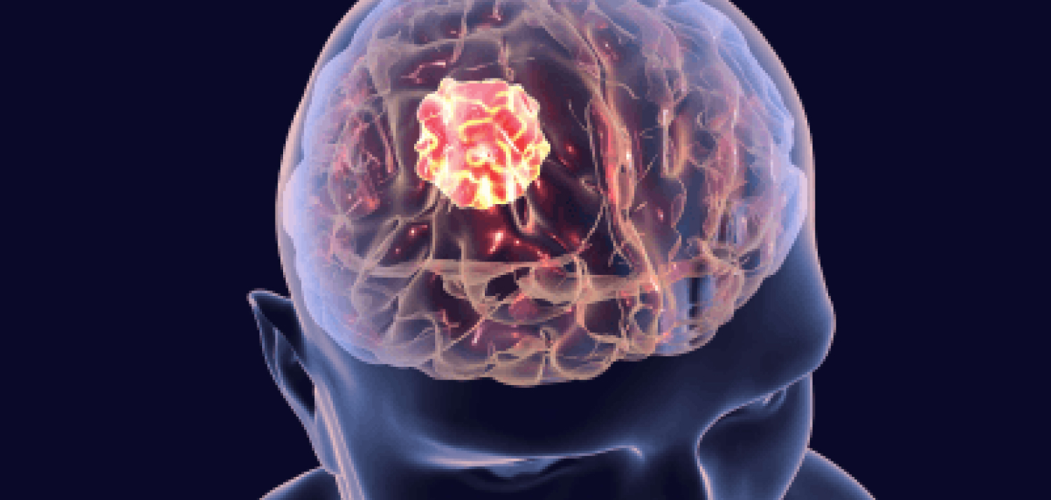 Understanding Brain Tumour Surgery: Procedures, Risks, and Recovery